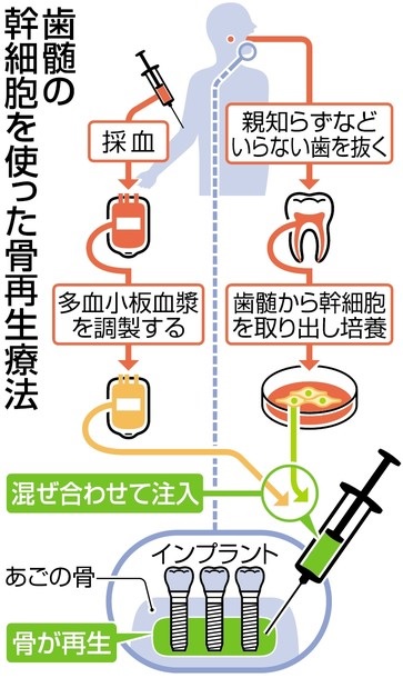 歯髄の骨再生